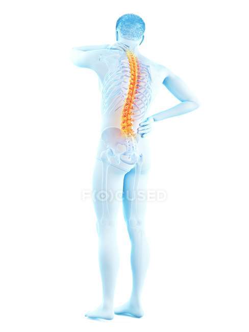 Cuerpo masculino con dolor de espalda en la vista trasera, ilustración conceptual . - foto de stock