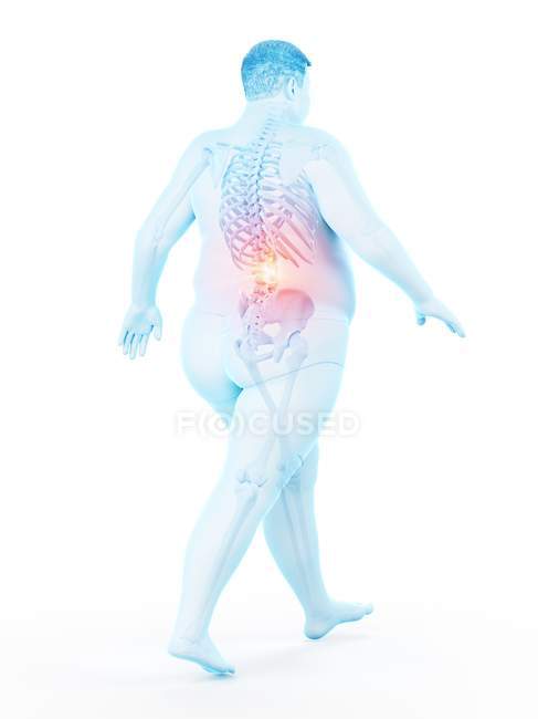 Gehen übergewichtige männliche Silhouette mit sichtbaren Rückenschmerzen, digitale Illustration. — Stockfoto