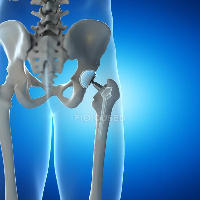 Ortopedia reemplazo de cadera sobre fondo azul, ilustración digital . - foto de stock