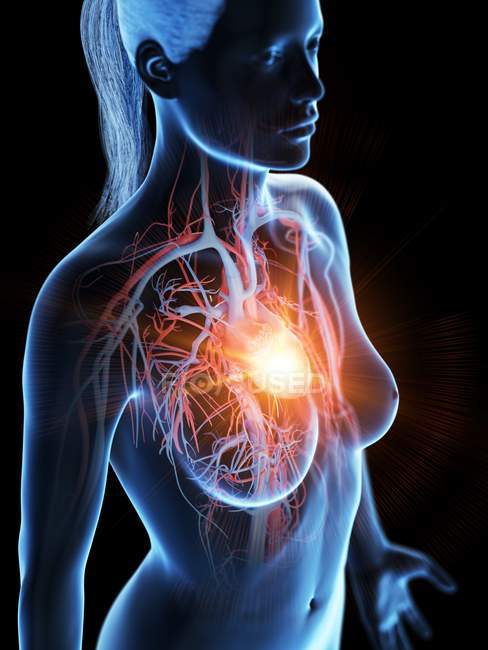 Ataque cardíaco en el cuerpo humano, ilustración conceptual . - foto de stock