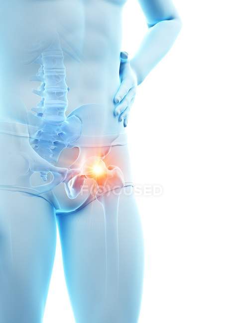Male body silhouette with visible hip pain, digital illustration. — Stock Photo