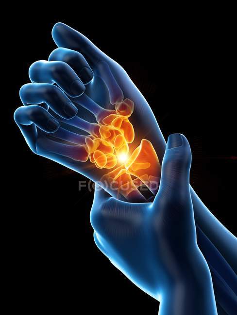 Abstract human hands with wrist pain, conceptual illustration. — Stock Photo