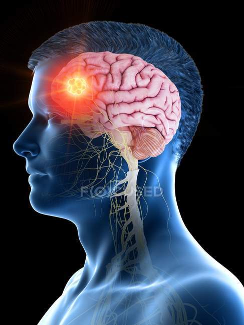 Пухлина мозку у чоловічому тілі, концептуальна комп'ютерна ілюстрація . — стокове фото