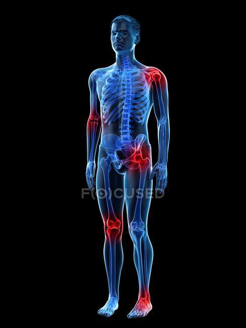 Corpo umano con punti di dolore articolare, illustrazione concettuale . — Foto stock
