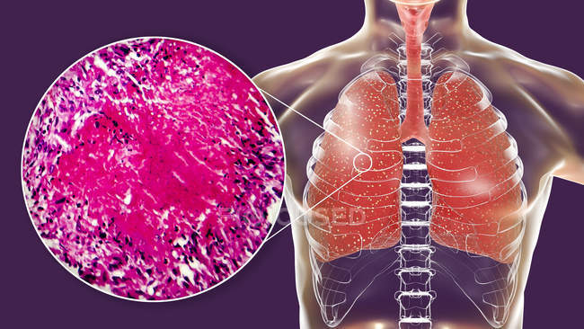 Malattia ausiliaria della tubercolosi nei polmoni, illustrazione digitale e micrografo leggero . — Foto stock
