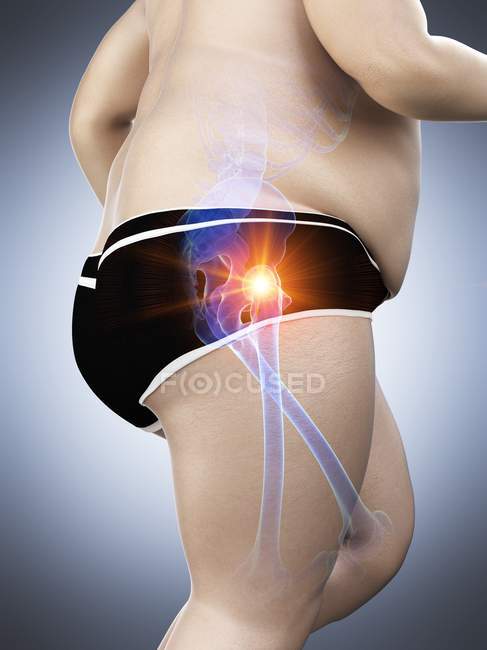 Silhouette di corridore obeso con dolore all'anca, illustrazione al computer . — Foto stock