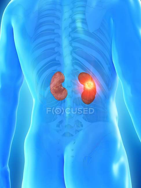 Рак нирок у чоловічому тілі, концептуальний цифровий приклад. — стокове фото