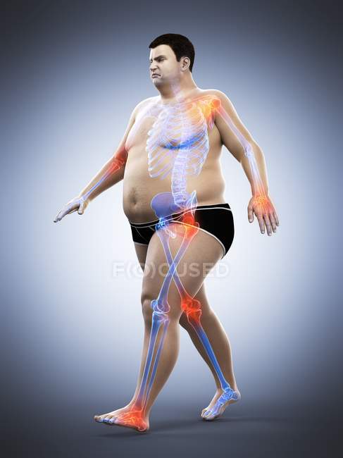 Silueta del hombre obeso que camina que tiene dolor en las articulaciones, ilustración por computadora . - foto de stock