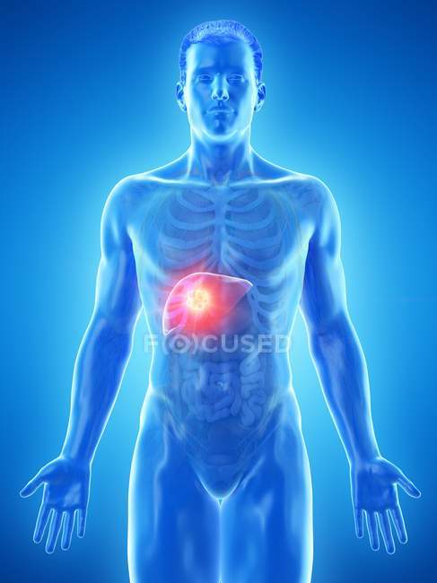 Cáncer de hígado en silueta corporal masculina, ilustración digital . - foto de stock