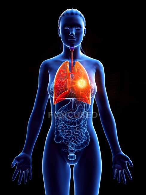 Пухлина легень у жіночому тілі на синьому тлі, цифрове зображення. — Stock Photo