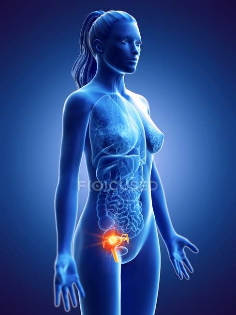Cáncer uterino en el cuerpo femenino, ilustración conceptual por computadora . - foto de stock