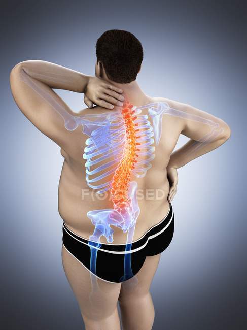 Fettleibige männliche Körper in Hochformat mit Rückenschmerzen, digitale Illustration. — Stockfoto