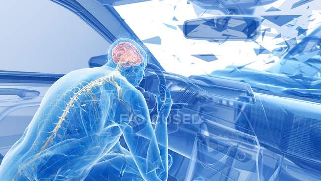 Ilustración de rayos X del riesgo de lesiones cerebrales durante un accidente de tráfico frontal, ilustraciones digitales . - foto de stock