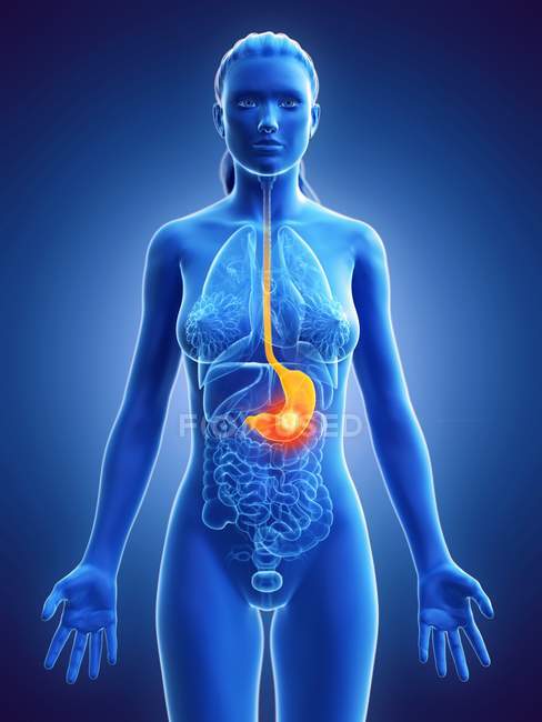 Рак шлунка в жіночому тілі, концептуальна комп'ютерна ілюстрація. — стокове фото