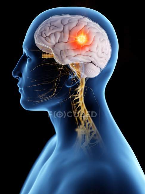 Tumore al cervello nel corpo maschile, illustrazione concettuale del computer
. — Foto stock