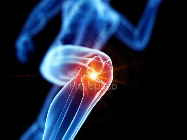 Абстрактный силуэт бегуна с болью в колене, концептуальная компьютерная иллюстрация . — стоковое фото
