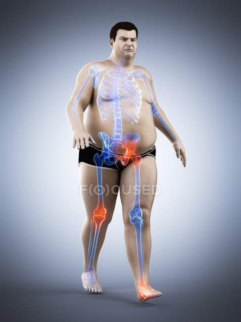 Silhouette of walking obese man having joint pain, computer illustration. — Stock Photo