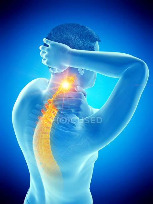 Männlicher Körper mit sichtbaren Nackenschmerzen, konzeptionelle Illustration. — Stockfoto
