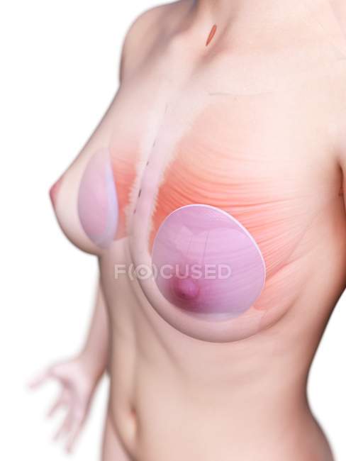 Анатомия грудных имплантатов в женском теле 3D модель, цифровая иллюстрация . — стоковое фото