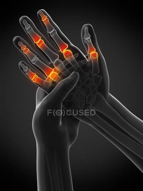 Mains humaines abstraites avec douleur des doigts, illustration conceptuelle . — Photo de stock
