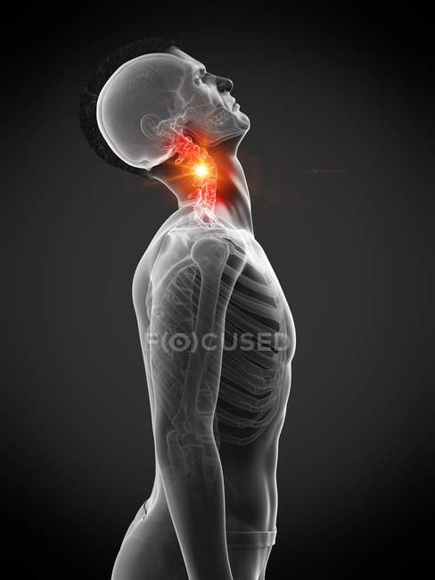 Silueta humana abstracta con cuello lesionado con dolor, ilustración conceptual . - foto de stock