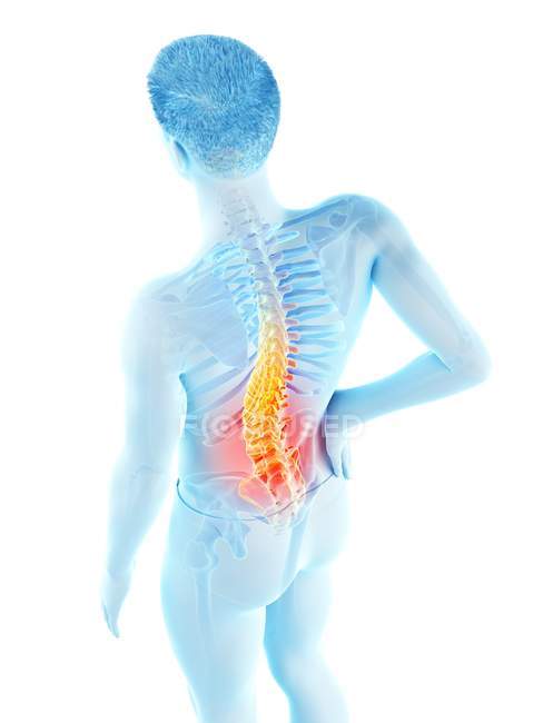 Männlicher Körper mit Rückenschmerzen im Hochwinkel, konzeptionelle Illustration. — Stockfoto