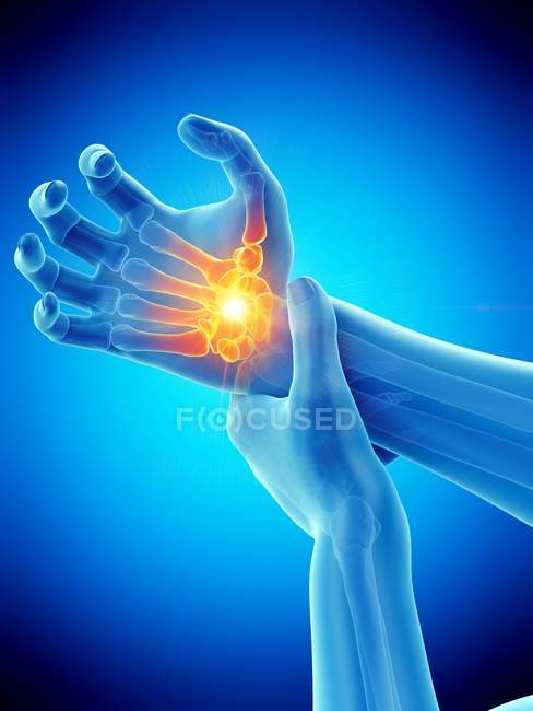 Mãos masculinas com dor de pulso brilhante, ilustração conceitual . — Fotografia de Stock