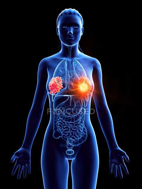 Жіноче абстрактне тіло з сяючим раком молочної залози, концептуальна комп'ютерна ілюстрація . — стокове фото