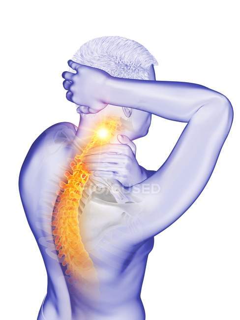 Abstrakter männlicher Körper mit sichtbaren Nackenschmerzen, konzeptionelle Illustration. — Stockfoto