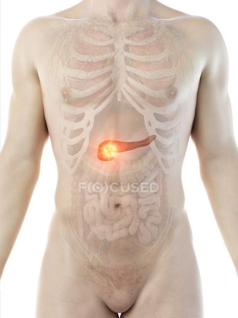 Cáncer de páncreas en el cuerpo masculino, ilustración conceptual por computadora
. - foto de stock