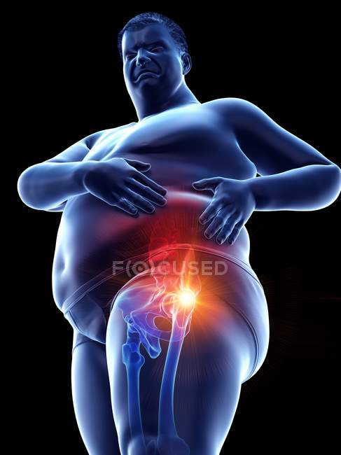 Silhouette eines fettleibigen Mannes mit Hüftschmerzen, digitale Illustration. — Stockfoto