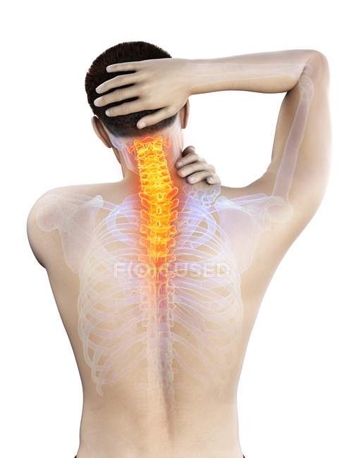 Corpo maschile in vista posteriore con dolore al collo visibile, illustrazione concettuale
. — Foto stock