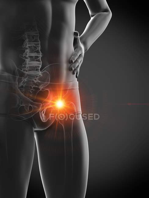 Silhouette del corpo maschile con dolore visibile all'anca, illustrazione digitale . — Foto stock