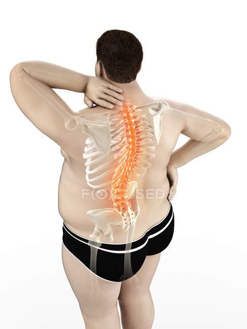 Obese male body in high angle view with back pain, digital illustration. — Stock Photo
