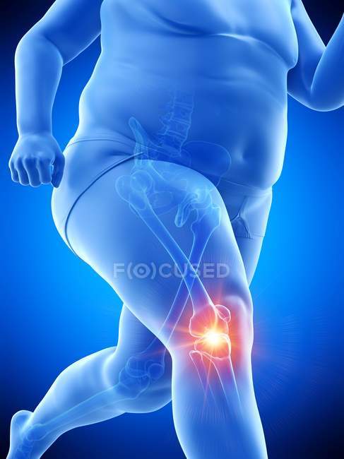 Silhouette of male obese runner having knee pain, conceptual digital illustration. — Stock Photo
