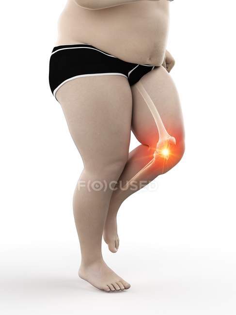 Silhouette of male obese runner having knee pain, conceptual digital illustration. — Stock Photo