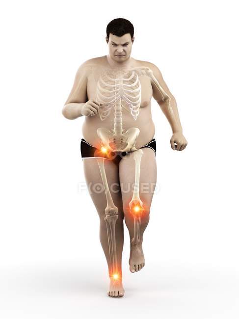 Fettleibige Läuferin mit Gelenkschmerzen, Computerillustration. — Stockfoto