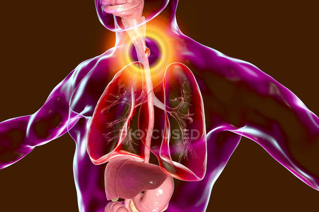 Esophageal cancer in male body, abstract digital illustration. — Stock Photo