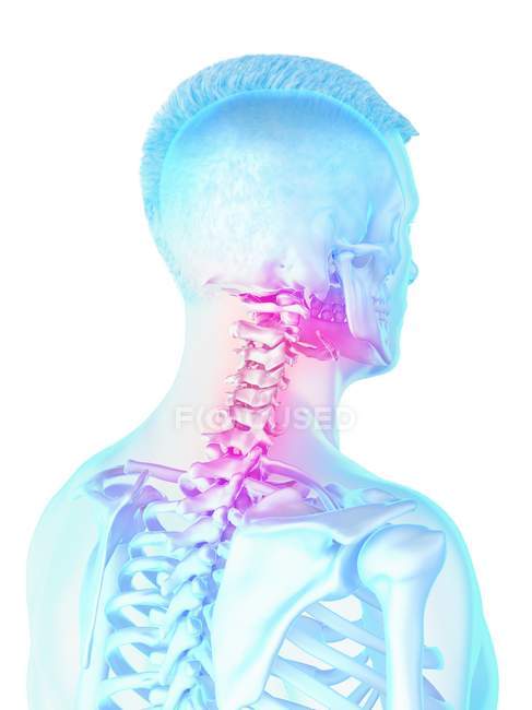 Мужской силуэт с видимой болью в шее, концептуальная компьютерная иллюстрация . — стоковое фото