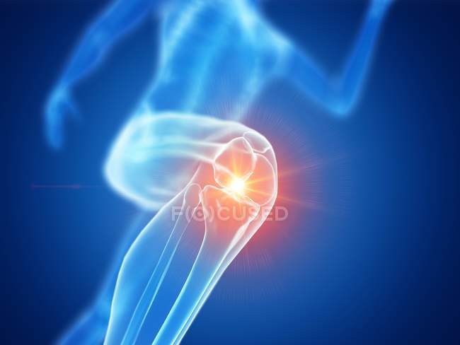 Abstract runner silhouette with knee pain, conceptual computer illustration. — Stock Photo