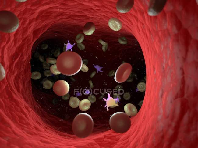 Cellules sanguines malades avec bactéries, illustration informatique
. — Photo de stock