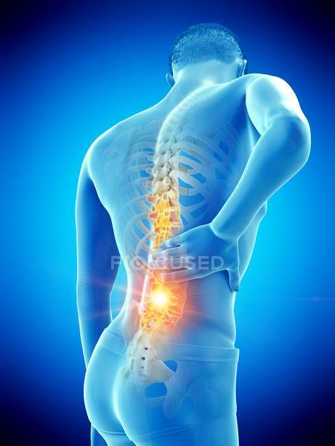 Silueta masculina con dolor de espalda sobre fondo azul, ilustración conceptual . - foto de stock