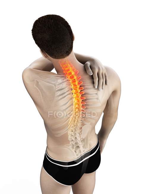Silueta masculina con la mano en la inflamación del dolor de espalda, ilustración conceptual
. - foto de stock