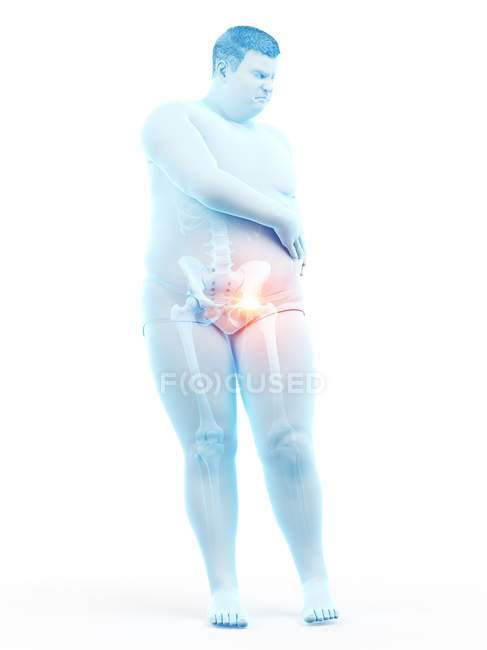 Silhouette d'homme obèse avec douleur à la hanche, illustration numérique . — Photo de stock