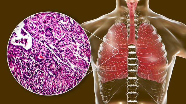 Tuberculose miliaire pulmonaire, illustration numérique et micrographie photonique . — Photo de stock