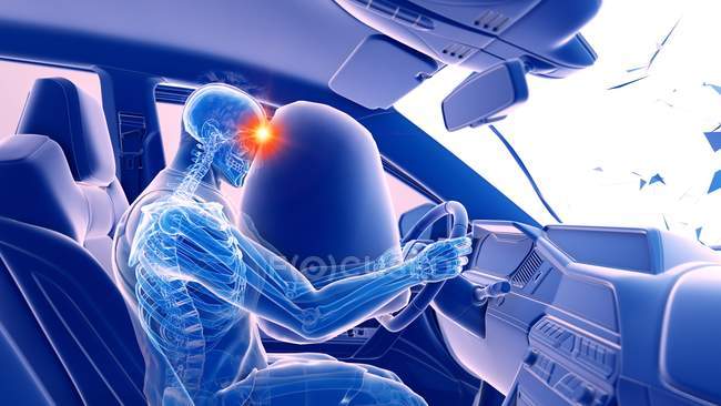 X-ray illustration of risk of head injury while head-on car crash, digital artwork. — Stock Photo