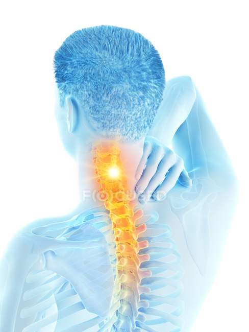 Cuerpo masculino abstracto con dolor de cuello visible, ilustración digital . - foto de stock