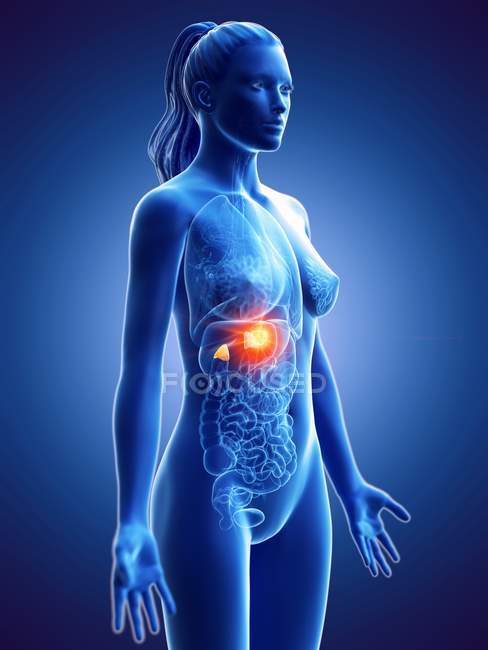 Weiblicher Körper mit Nebennierenkrebs, Computerillustration. — Stockfoto