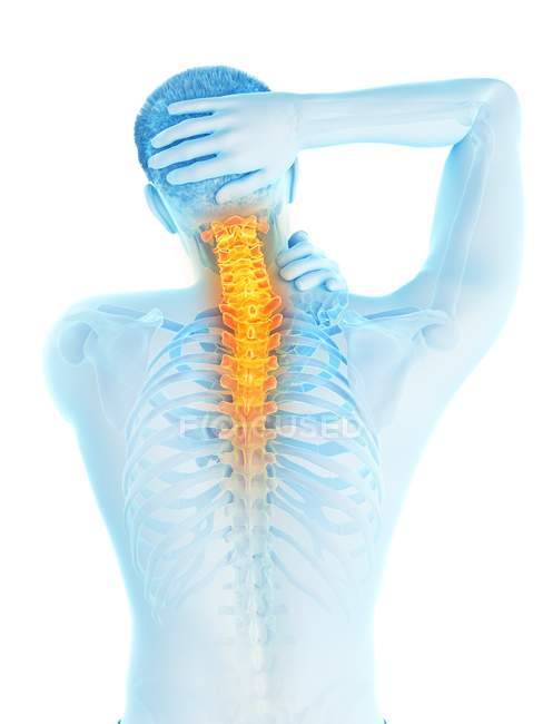 Corpo masculino em visão traseira com dor visível no pescoço, ilustração conceitual
. — Fotografia de Stock