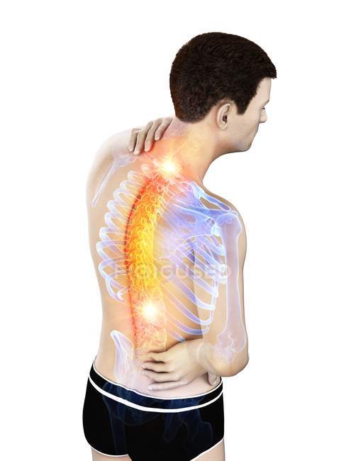 Мужской силуэт с болью в спине под высоким углом обзора, концептуальная иллюстрация . — стоковое фото